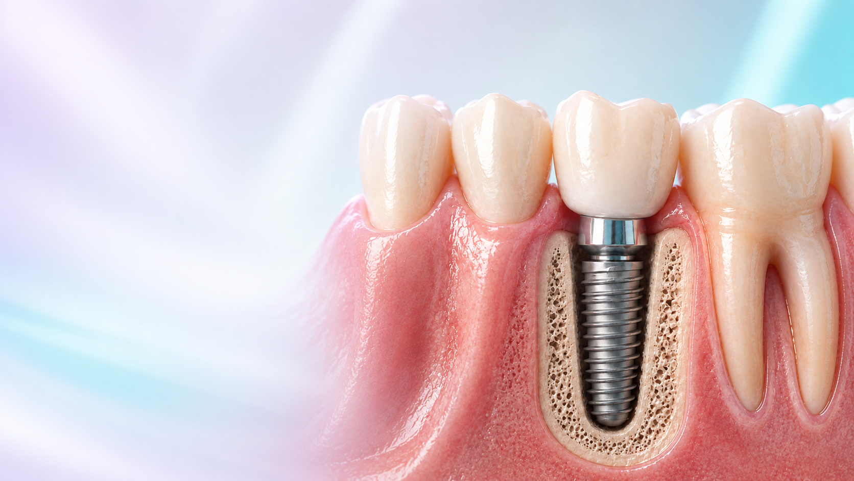 Representación tridimensional de una corona dental y un implante integrado al hueso